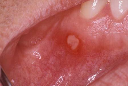 Recurrent oral aphthae. . Icd 10 aphthous ulcer
